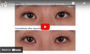 Aegyo Sal Filler - Patient Testimonial with Dr. Kenneth Kim Plastic Surgery Click to See Video