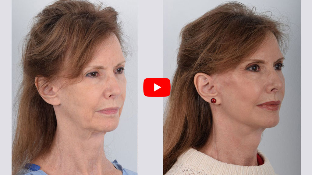 Awake Bloodless Facelift Surgery | NO General Anesthesia | Deep Plane Facelift click to see video