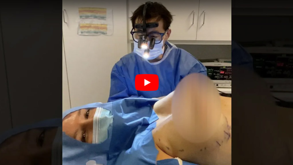 Awake Breast Augmentation Surgery Video