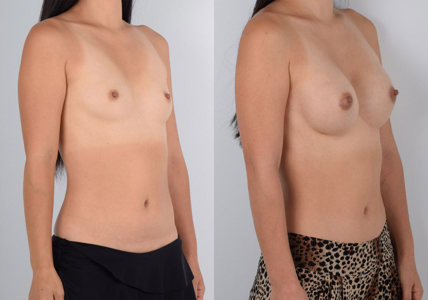 Asian female in her 40s wanted fuller breasts that would achieve her aesthetic goals as well as suit her active lifestyle. After consulting with Dr. Kim about her desired appearance and surgical options, they chose an implant size and surgical approach (areolar incision) that would do both - be aesthetically appealing and not impede her range of motion. She underwent awake, bloodless breast augmentation surgery under local anesthesia, which resulted in quicker recovery without narcotic pain medication and softer, supple breasts. The after photos show no visible scars and fuller, natural-looking breasts that are proportional to the patient’s overall frame.
   

