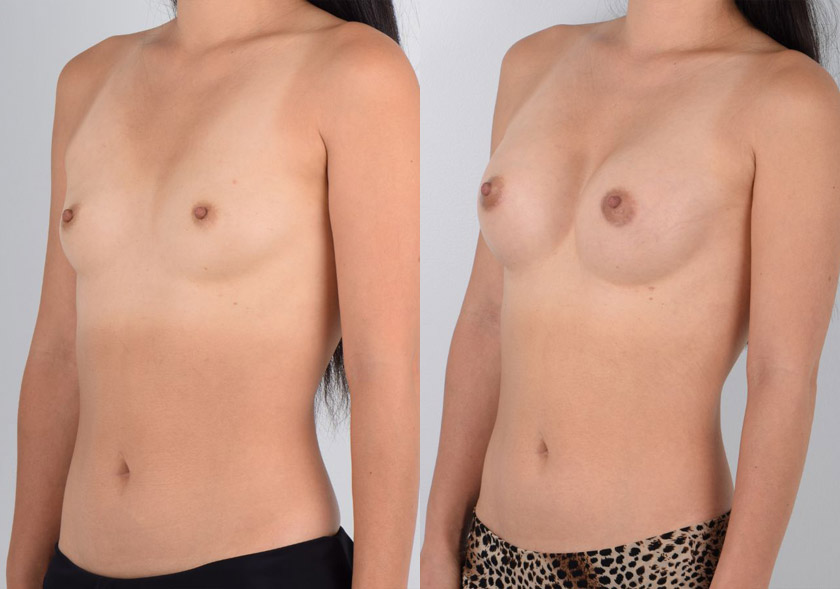 Asian female in her 40s wanted fuller breasts that would achieve her aesthetic goals as well as suit her active lifestyle. After consulting with Dr. Kim about her desired appearance and surgical options, they chose an implant size and surgical approach (areolar incision) that would do both - be aesthetically appealing and not impede her range of motion. She underwent awake, bloodless breast augmentation surgery under local anesthesia, which resulted in quicker recovery without narcotic pain medication and softer, supple breasts. The after photos show no visible scars and fuller, natural-looking breasts that are proportional to the patient’s overall frame.
   

