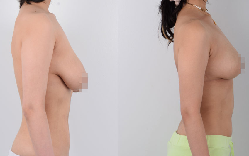  Female, Breast Reduction and Lift, Age: