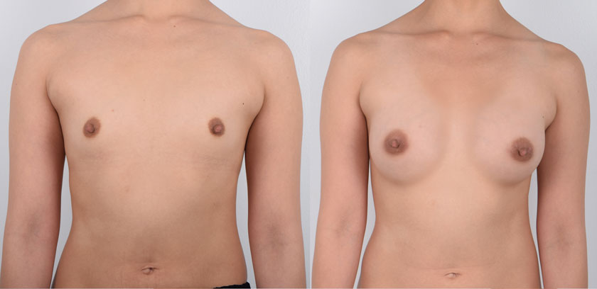 Female in her 30s with naturally smaller breasts wanted to enhance her breast size. She wanted natural-looking results that would be proportionate to her body frame. She received awake breast augmentation surgery under local anesthesia. Dr. Kim performs this procedure using a local anesthetic which allows the patient to be fully awake during surgery. Dr. Kim’s approach does not subject the patient to the risks and dangers of general anesthesia or sedation. This patient did not experience pain during surgery and was able to recover immediately. The after photos show natural-looking results that complement the patient’s body shape and frame.
   


