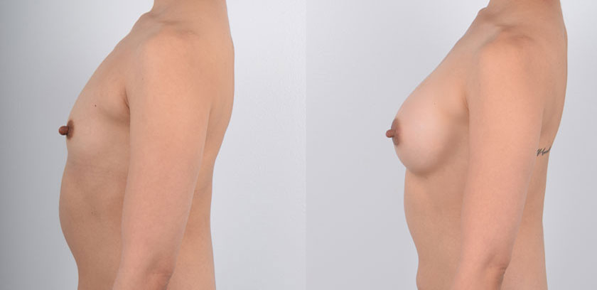Female in her 30s with naturally smaller breasts wanted to enhance her breast size. She wanted natural-looking results that would be proportionate to her body frame. She received awake breast augmentation surgery under local anesthesia. Dr. Kim performs this procedure using a local anesthetic which allows the patient to be fully awake during surgery. Dr. Kim’s approach does not subject the patient to the risks and dangers of general anesthesia or sedation. This patient did not experience pain during surgery and was able to recover immediately. The after photos show natural-looking results that complement the patient’s body shape and frame.
   

