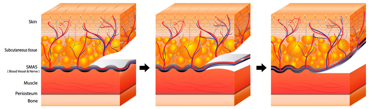 Deep plane skin layers