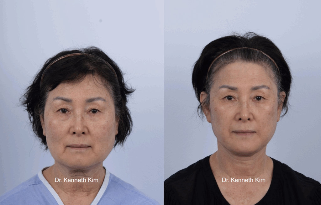 Asian female in her 70s underwent an awake facelift and neck lift to address facial sagging in the lower face (jowls and jawline), loose skin in the neck, deepened nasolabial folds around the nose, and marionette lines at the corners of the mouth. With age, the skin, fat, and muscles descend, causing the lower face to appear more rounded or square-shaped, which alters the overall facial shape. Dr. Kim performed an awake extended deep plane facelift and neck lift using local anesthesia only, without general anesthesia or IV sedation. The patient remained fully awake and able to breathe safely on her own, without being intubated or sedated. This approach avoids the risks associated with general anesthesia and twilight (IV) sedation including blood clots, prolonged recovery, and cognitive decline (memory loss and dementia). Traditional facelifts often rely on pulling the skin, leading to an unnatural, stretched appearance that does not last. Dr. Kim's technique involves releasing more facial ligaments and re-draping and repositioning (not pulling) the deeper layers of the facial muscle for long-lasting, natural-looking rejuvenation. His minimal bleeding method further promotes faster recovery and optimal healing. Another key component of his facelift approach is midface elevation, which restores cheek volume without the...
   

