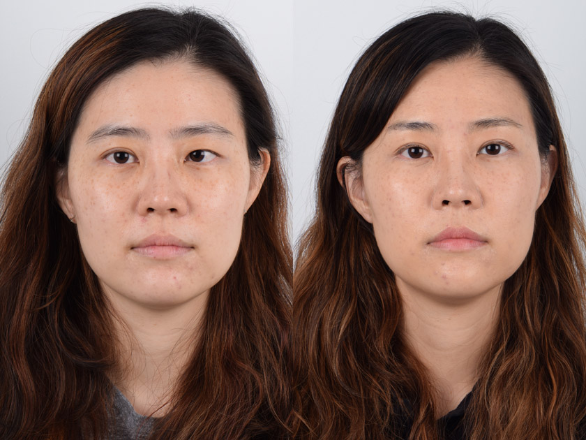 Asian female in her 20s had uneven eyelids and ptosis (droopy eyelid). She underwent revision Asian double eyelid surgery (prior eyelid surgery was performed elsewhere) and ptosis correction. Note in the after photo more even and natural-looking double eyelids creating balanced facial features.