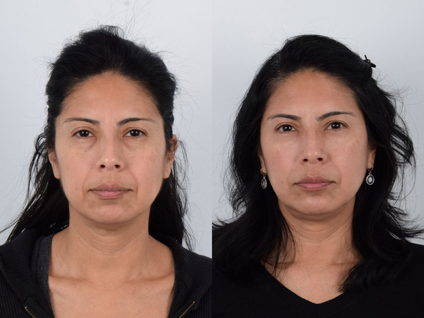 Female in her 40s had puffy under-eye bags and dark circles giving a tired and fatigued appearance. She received lower eyelid surgery (lower blepharoplasty) where the fat in the lower eyelids was repositioned. Note the after photo where the lower eyelid area is smooth without any bulge and dark shadows are no longer visible. The procedure resulted in a brighter and youthful appearance.
   

