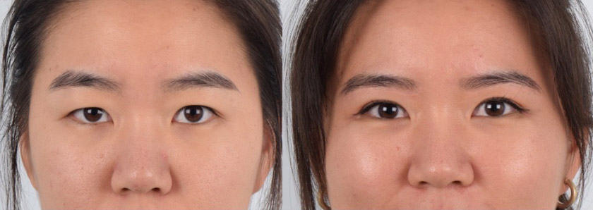 Bilateral sub brow lift with double eyelid on the right eye
   

