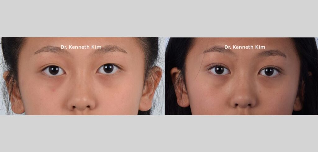  Female, Eyelid Surgery, Age:15-20