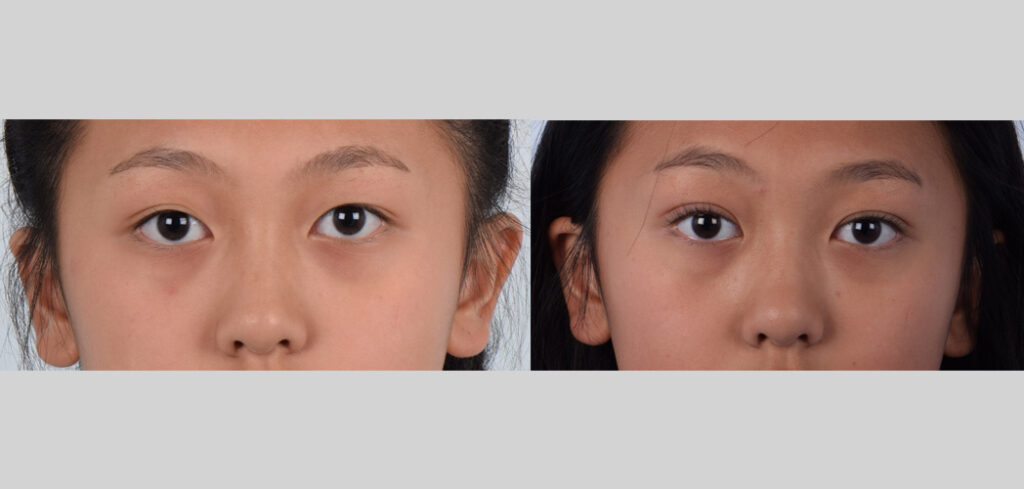  Female, Before and After Double eyelid surgery Photos, Age:15-20