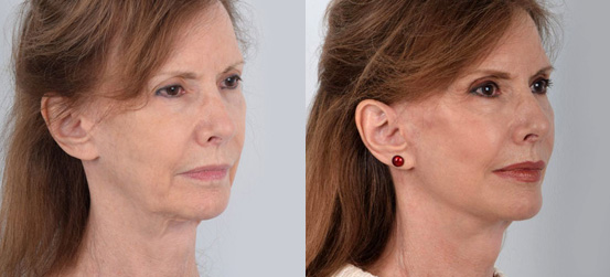 Facelift patient before and after picture