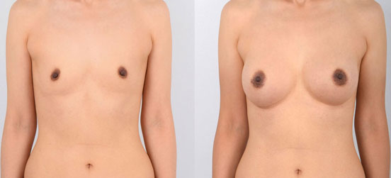 Breast Augmentation patient before and after picture