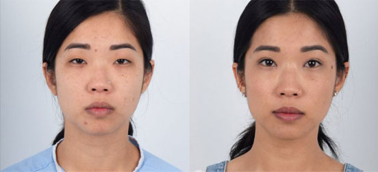 Eyelid Surgery patient before and after picture