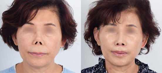 Nose Surgery patent before and after picture