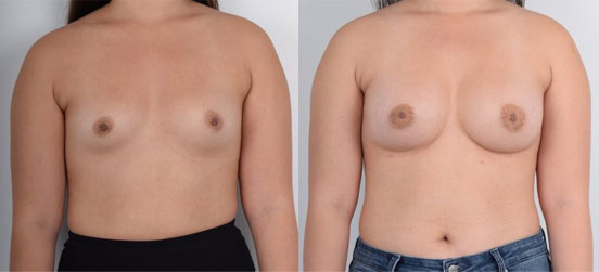 Breast Augmentation patent before and after picture