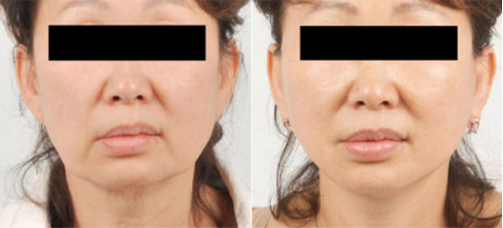 Facelift patent before and after picture