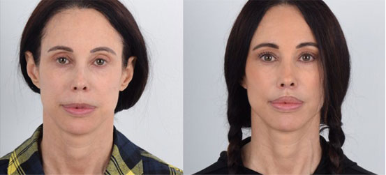Lip lift patient before and after picture