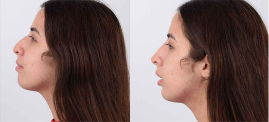 Filler patent before and after picture