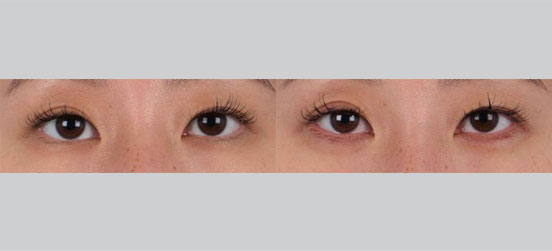 Filler on Eyelid patent before and after picture