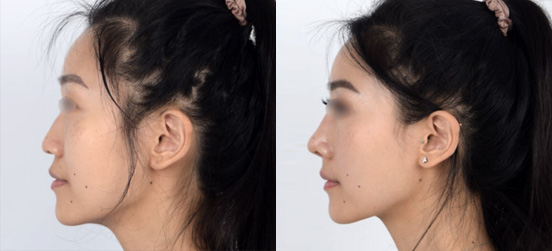 Nose Surgery patient before and after picture