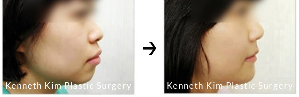 Genioplasty before and after image