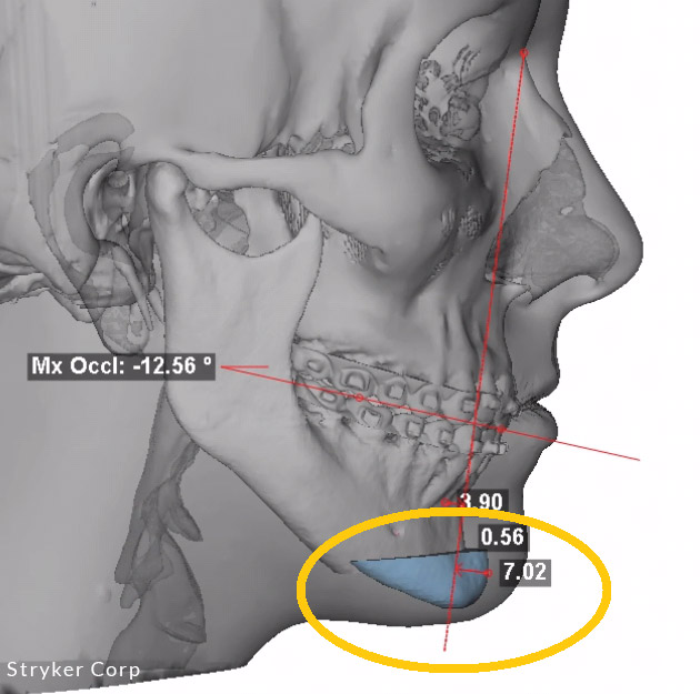 Genioplasty X-Ray image