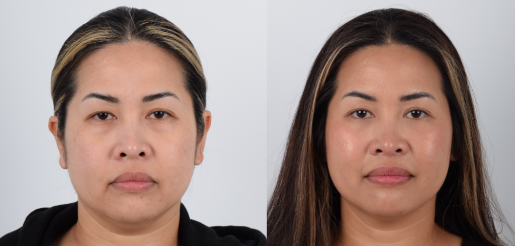  Female, Lower blepharoplasty / lower eyelid surgery, Age: