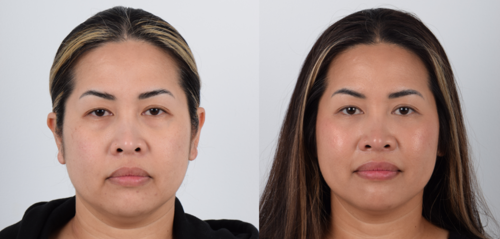  Female, Eyelid Surgery, Age: