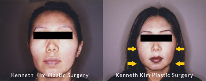 Midface soft tissue drooping Before and After Front view