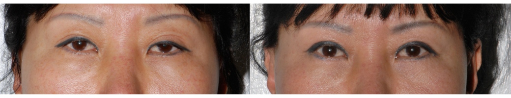 Moderate Ptosis 3