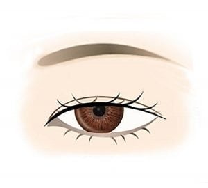 Moderate Ptosis sketch image