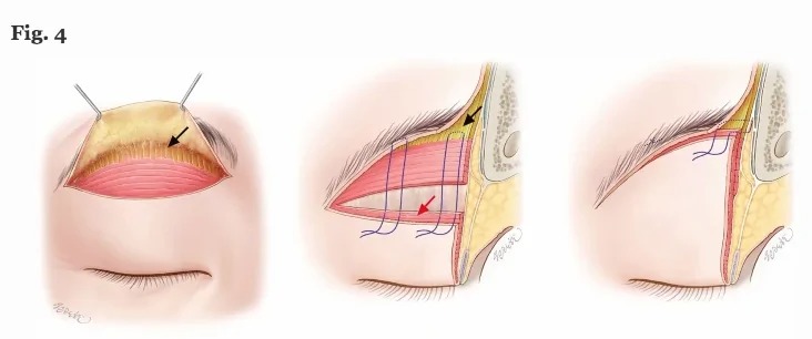 Eyelid Surgery Illustration picture