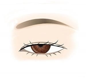 Severe Ptosis sketch image