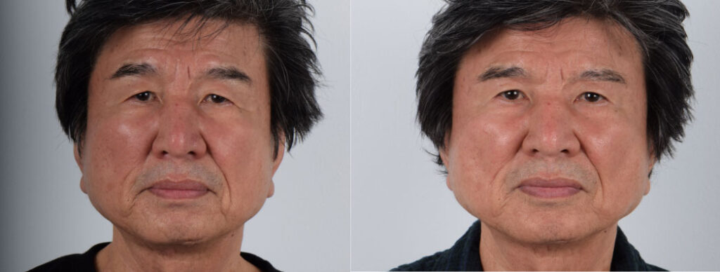  Male, Eyelid Surgery, Age:45 - 50