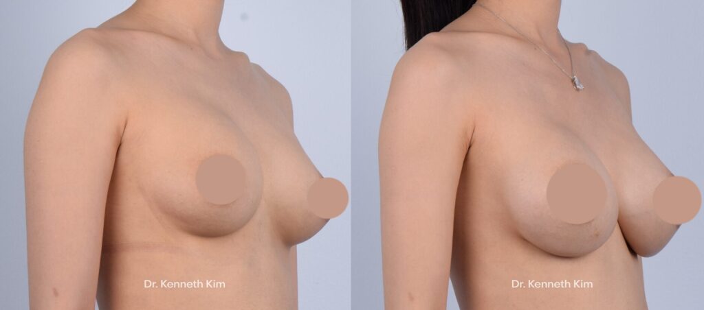 Female patient in her 20s underwent an awake revision breast augmentation to improve the appearance of her breasts. She wanted fuller volume with a smoother, more natural shape. Her prior surgery was performed elsewhere, and she specifically sought Dr. Kim for his awake approach to revision breast implant surgery. The revision breast augmentation was performed using only local anesthesia (no general anesthesia, no IV sedation, no intubation), allowing her to remain fully awake and comfortable throughout the procedure. Dr. Kim's awake breast augmentation avoids the risks associated with general anesthesia, including life-threatening blood clots and memory loss. His minimal bleeding method significantly minimizes the risk of capsular contracture, a condition where scar tissue causes the breast to harden and distort. His approach leads to faster recovery, minimal downtime, and more natural-looking, softer results. Dr. Kim's advanced breast technique includes creating an internal bra using the patient's own tissue to support the implants, improving long-term results and breast shape.  
   

