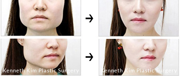 V-Shaped Jaw Reduction Surgery before and after images