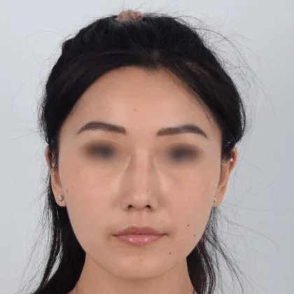 Asian female in her 20s underwent rhinoplasty augmentation to achieve a higher bridge and sharper tip nose. Dr. Kim utilized the patient’s rib cartilage to define her nose shape. He performed the procedure using local anesthesia so that the patient was fully awake during surgery and did not need to go under. She recovered quickly and the after photos show a defined, beautifully enhanced nose that complements her face.