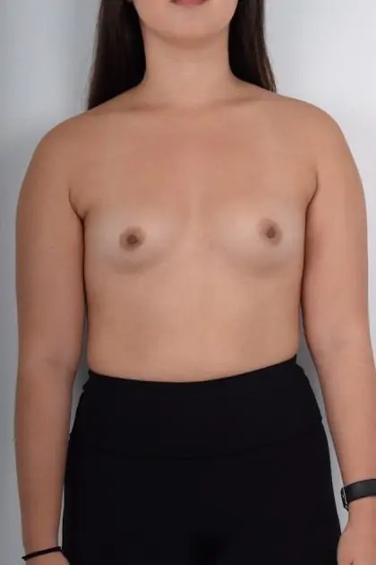 Breast Augmentation Before & After Patient #4173