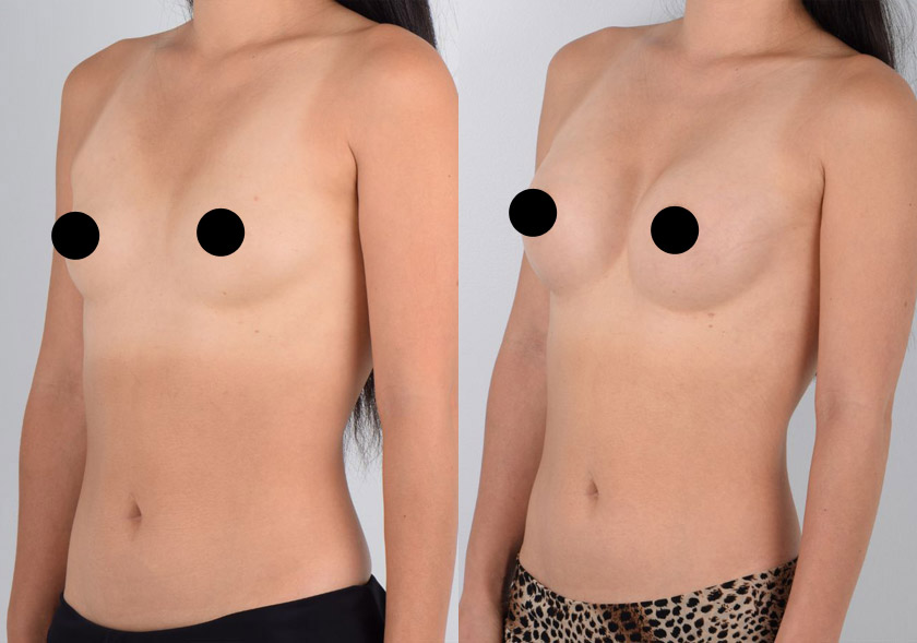 Asian female in her 40s wanted fuller breasts that would achieve her aesthetic goals as well as suit her active lifestyle. After consulting with Dr. Kim about her desired appearance and surgical options, they chose an implant size and surgical approach (areolar incision) that would do both – be aesthetically appealing and not impede her range of motion. She underwent awake, bloodless breast augmentation surgery under local anesthesia, which resulted in quicker recovery without narcotic pain medication and softer, supple breasts. The after photos show no visible scars and fuller, natural-looking breasts that are proportional to the patient’s overall frame.