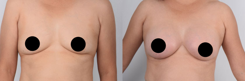 Asian female in her 20s underwent awake breast augmentation with Dr. Kenneth Kim. Dr. Kim performs breast enlargement surgery using local anesthesia, thus avoiding the widely reported and well-known risks and complications of general anesthesia (e.g. aspiration, cardiac arrest, cognitive dysfunction). The use of local anesthesia in breast augmentation results in the fastest recovery possible with no need for narcotic pain medications. The patient remained fully awake during surgery and did not experience pain or discomfort. Following surgery, the patient can walk and move without assistance and is not subject to nausea and vomiting, chills, and disorientation which are common side effects of general anesthesia that begin right after surgery. Dr. Kim’s patients are able to safely walk out of the operating room on their own and make the quickest recovery possible.