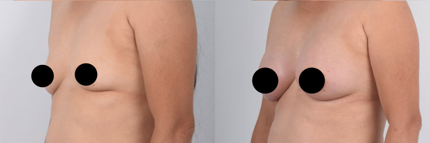 Direct to Implant Breast Reconstruction in Beverly Hills and Los Angeles