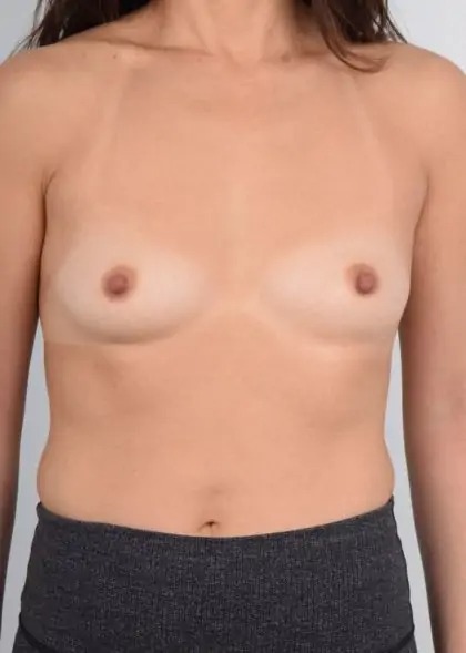 Breast Augmentation Before & After Patient #4608