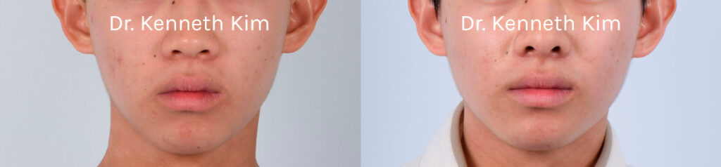 Male patient in his early 20s wanted to augment a small and recessed chin. There are two types of chin augmentation surgery—a genioplasty where the chin bone is repositioned and a chin implant procedure. This patient wanted a subtle enhancement and received a chin implant that was precisely placed into his chin bone, creating a stronger, more defined chin. The post-op photos show natural-looking results and demonstrate how the enhanced chin projection improved his overall facial harmony and balance.
   


