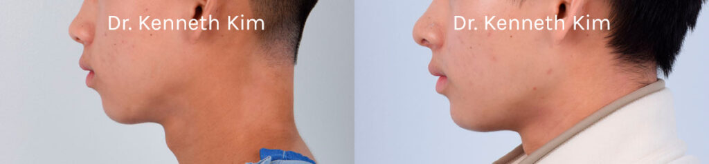Male patient in his early 20s wanted to augment a small and recessed chin. There are two types of chin augmentation surgery—a genioplasty where the chin bone is repositioned and a chin implant procedure. This patient wanted a subtle enhancement and received a chin implant that was precisely placed into his chin bone, creating a stronger, more defined chin. The post-op photos show natural-looking results and demonstrate how the enhanced chin projection improved his overall facial harmony and balance.
   

