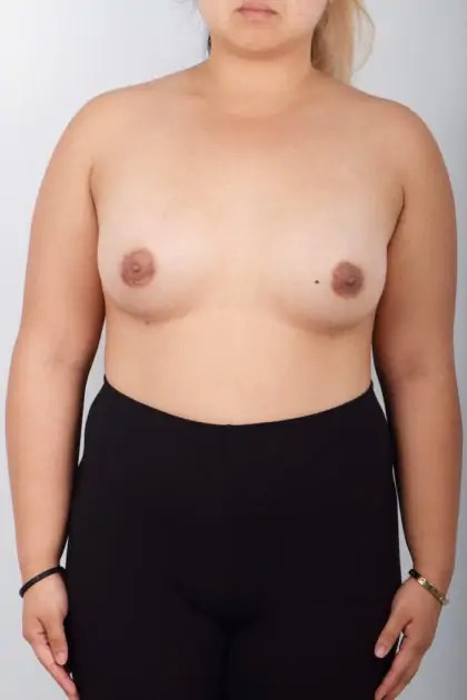 Breast Augmentation Before & After Patient #5009