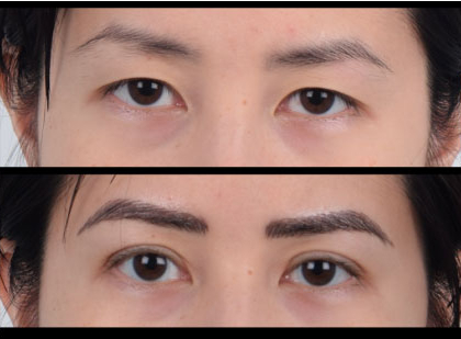 Asian female in her 30s with monolid eyes underwent Asian double eyelid surgery (Asian blepharoplasty). The after photo shows natural-looking, defined double eyelid folds that give the appearance of softer and more open eyes.
