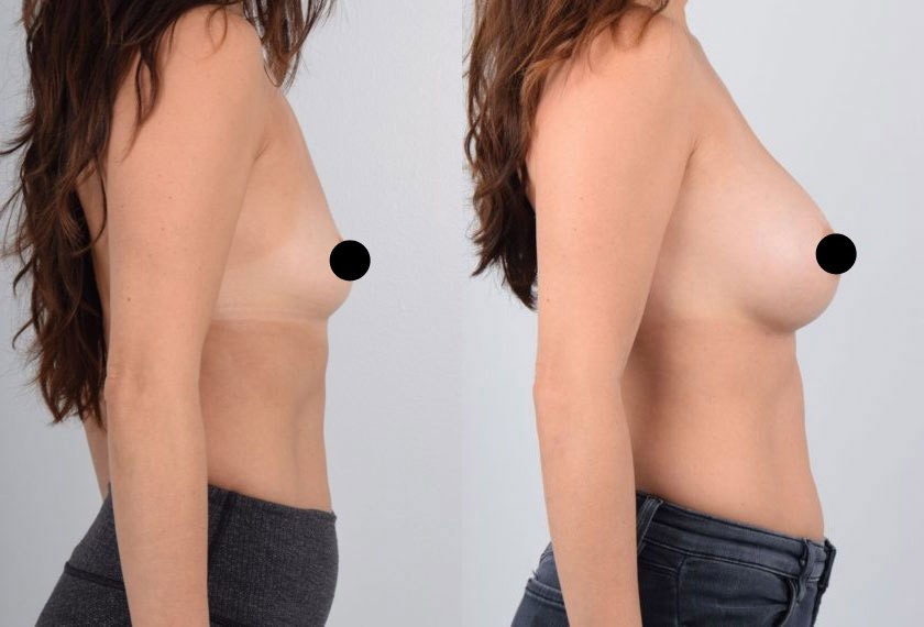 Female in her 20s wanted breast augmentation surgery to increase the size and shape of her breasts. She consulted with Dr. Kim because he performs this procedure using local anesthesia, which is the safest way to have breast enlargement surgery. She was fully awake during surgery and was able to relax without feeling any discomfort. The use of local anesthesia ensured a fast recovery with no downtime. The after photos show natural-looking, fuller breasts that are proportionate to the patient’s frame and the placement of the implants also created optimal cleavage.