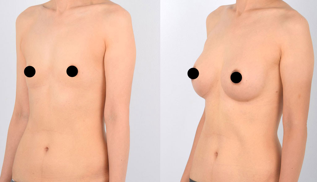 Best Breast Augmentation Los Angeles