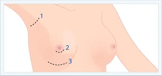 breast enlargement incisions